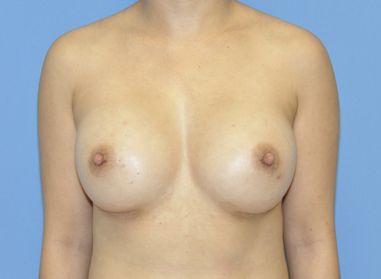 Breast Augmentation Before & After Patient 04