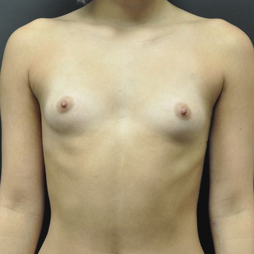 Breast Augmentation Before & After Patient 118