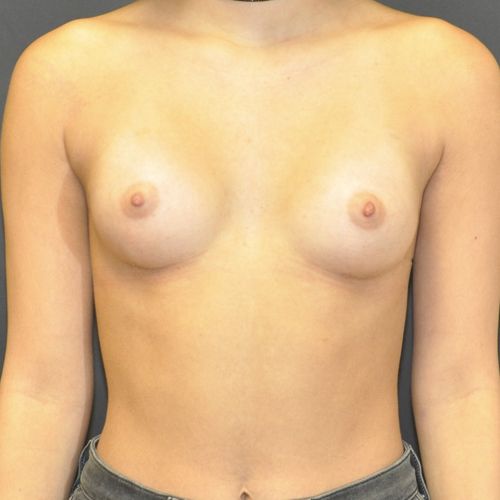 Breast Augmentation Before & After Patient 118