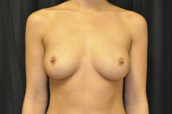Breast Augmentation Before & After Patient 25