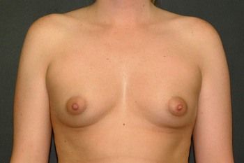 Breast Augmentation Before & After Patient 26