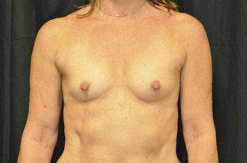 Breast Augmentation Before & After Patient 30