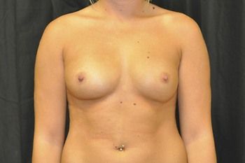 Breast Augmentation Before & After Patient 35