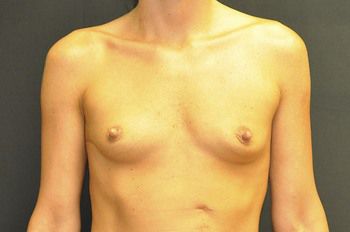 Breast Augmentation Before & After Patient 50