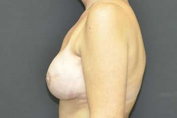 Breast Reconstruction Before & After Photo Patient 18 Thumbnail